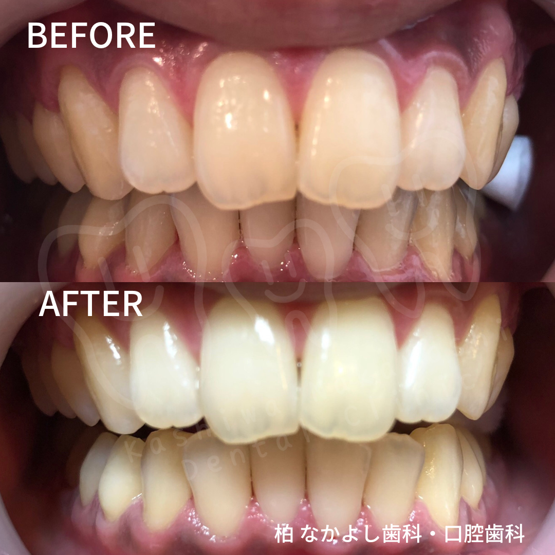 ホワイトニング　症例写真